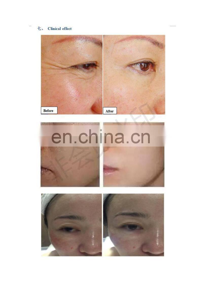 SEE YOU skin care whiten and wrinkle removal needleless injection skin tighten equipment