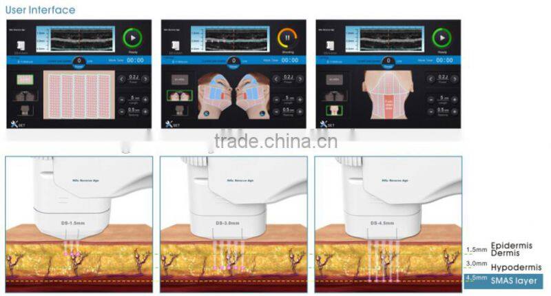 HIFU therapy high intensity focused therapeutic ultrasound