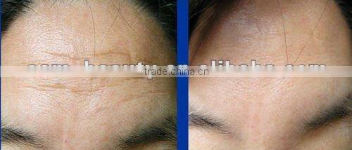 Aura Derma Skin Roller To Help Treat Deep Wrinkles & Scars 1.0mm L001