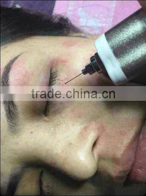 2015 Professional Skin Treatment Electrical Machine Plasma Mini laser for Freckles/Age Spots/,warts Removal Beauty Pen