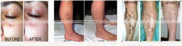 RBS03- Ramya 980nm laser RBS non-invasive spider veins treatment