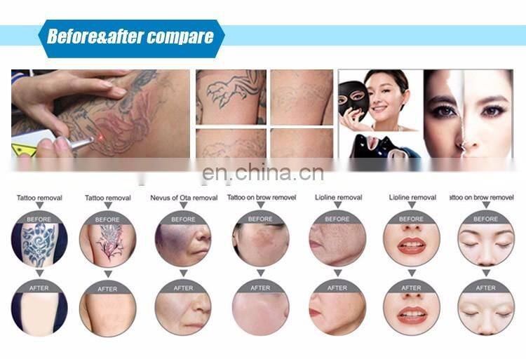 Fast treatment effect ND YAG Q- Switched tattoo removal machine ND Yag painless laser tattoo removal machine