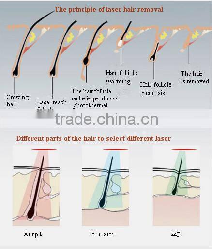 808 diode laser hair removal machine