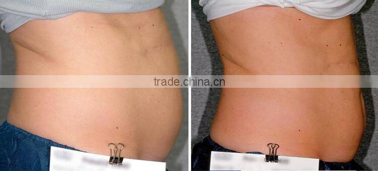 Fast cellulite reduction machine ultrasonic fat reduction hifu slimming treatments
