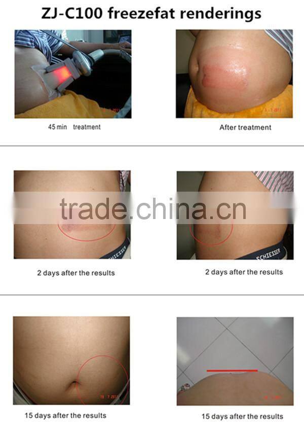 Zhengjia medical cryolipolysis freeze fat beauty machine with 4 handles
