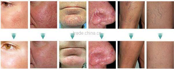 Professional RBS Vascular / varicose veins laser treatment machine / spider veins treatment