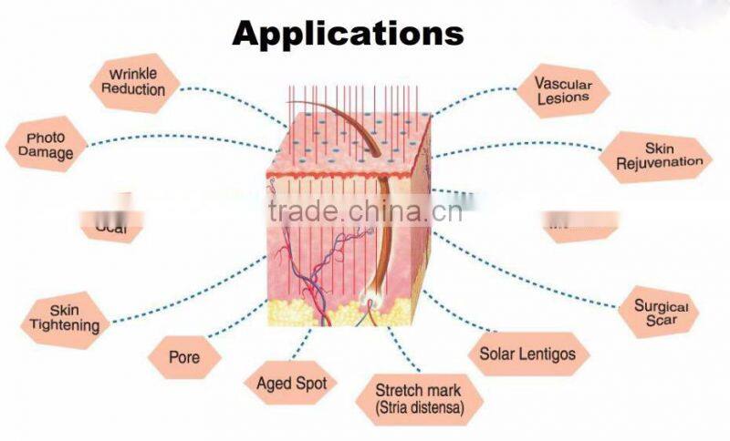 Hot selling professional 1550 diode laser acne scar removal anti aging