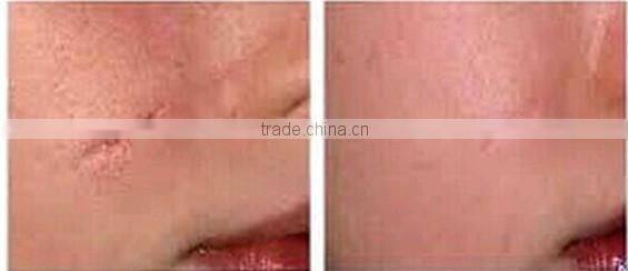 Newest and Hottest Microneedle zinuo 540 Derma Roller