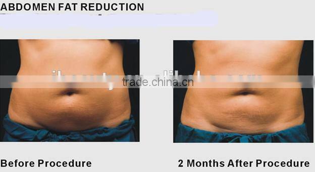 Cryotherapy fat freezing Cryotherapy equipment Cryotherapy machine for sale