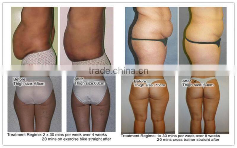 Cool Therapy Lipo Cryo Fat Freezing Machine