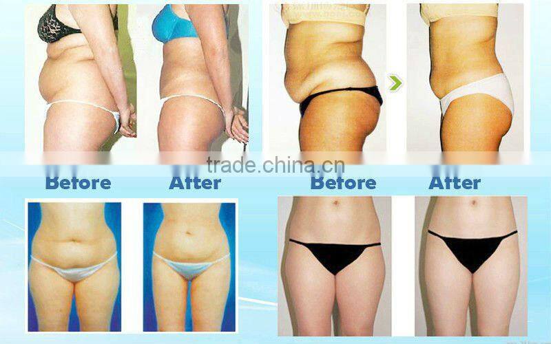 (CE)Most powerful body shaping machine - 4 in 1 ultrasonic rf vacuum lipo laser machine (S10)