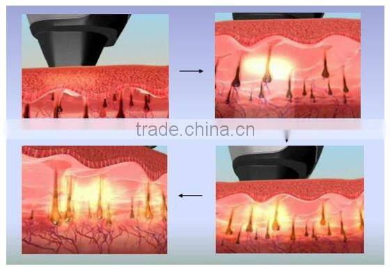 diode laser hair removal machine beauty equipments