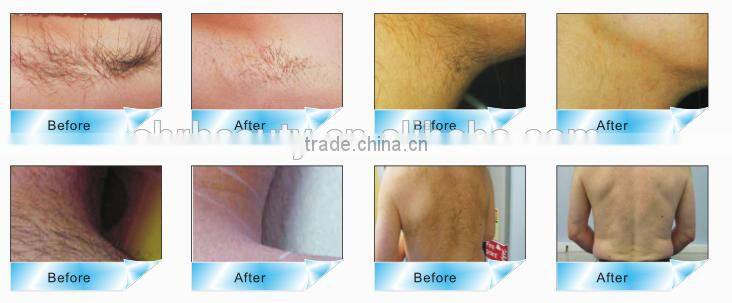 Factory price portable Elight RF hair removal machine with CE approved