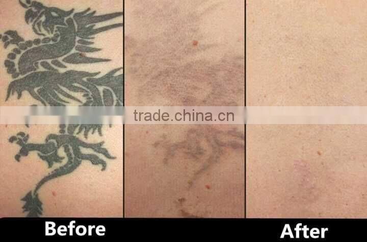 Cosmetic laser hair removal tatoo removal machine for beauty spa and laser clinic