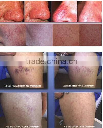 2016 Alibaba Thailand RBS spider vein removal beauty machine for sale