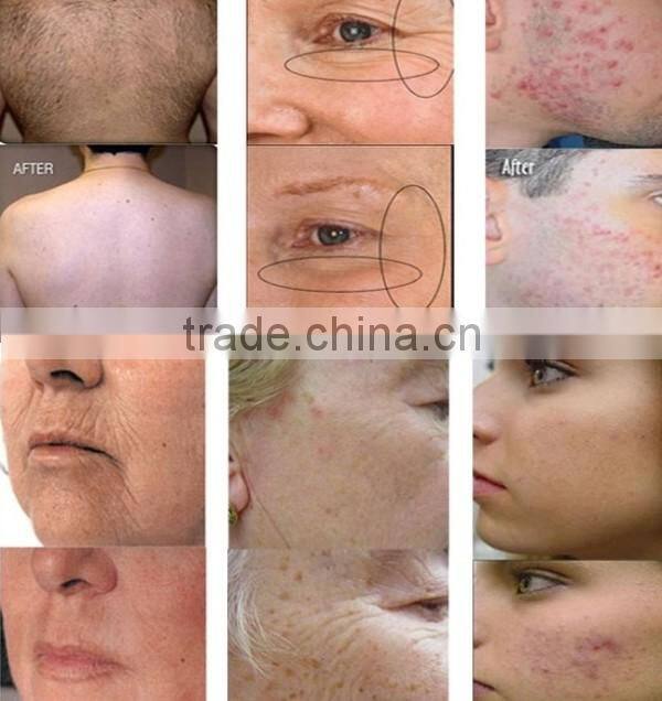 808nm diode vacuum shockwave therapy vacuum slimming machine