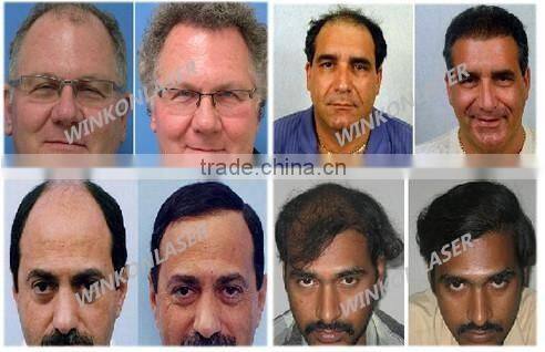 low level laser therapy / hair loss solution / anti hair loss