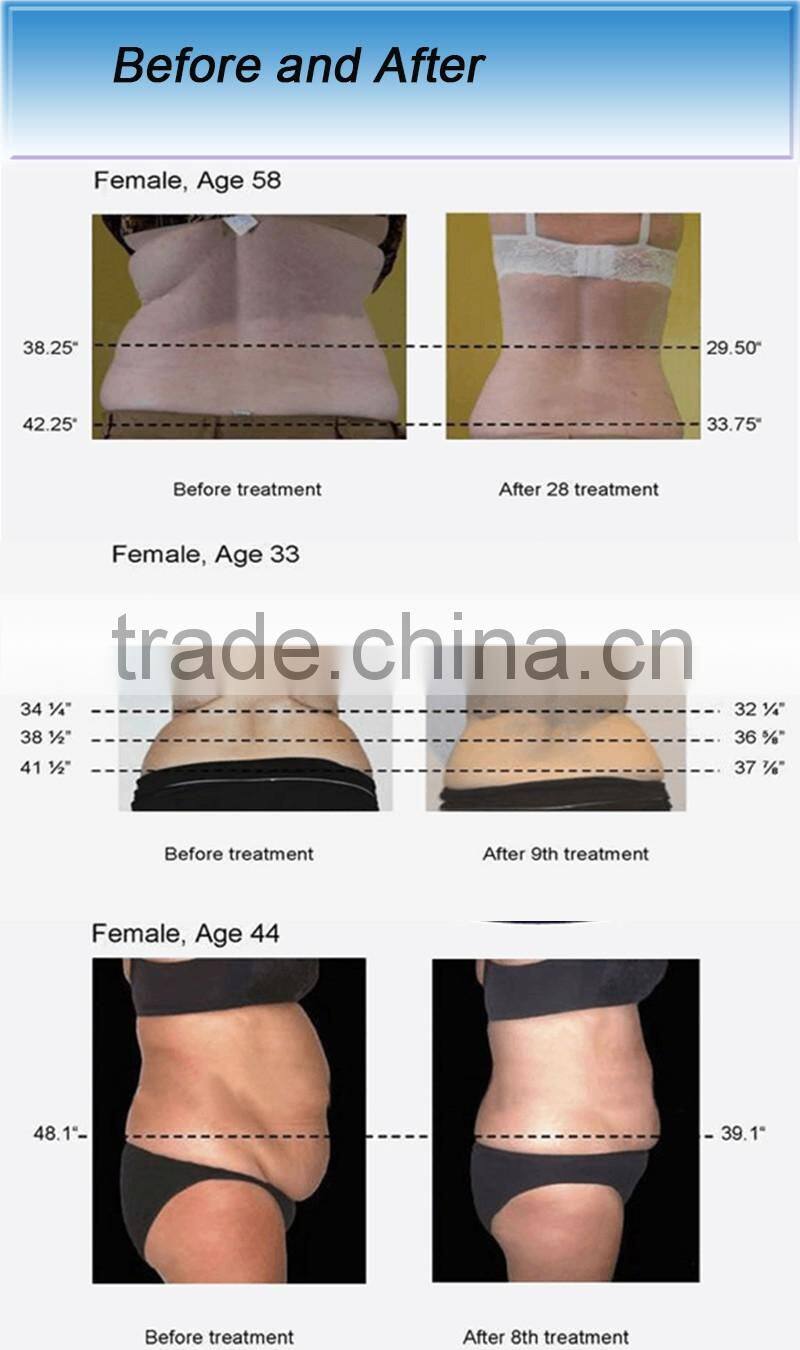 Ultrasonic liposuction cavitation focused slimming machine for sale