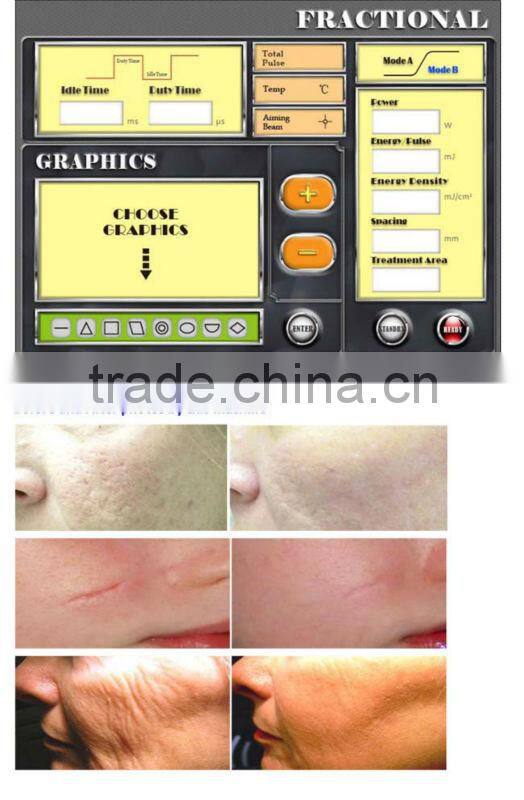 fractional laser skin treatment beauty machine