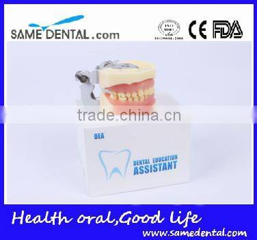 Dental Moderate Periodontal Disease Model Teaching Demonstration