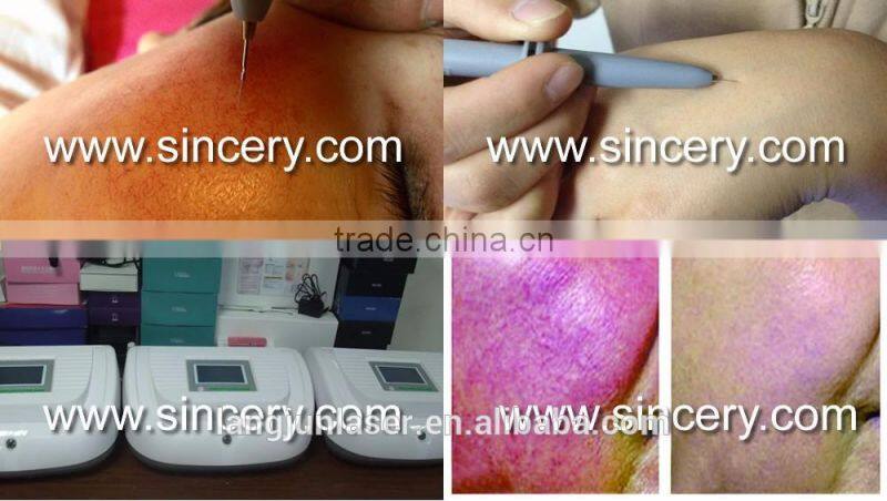 Beautiful Professional Cure Telangiectasia Treatment Vein Removal Equipment