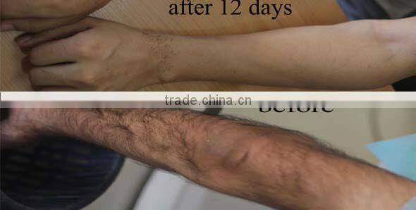 Medical standard 808 nm diode laser for hair removal and rejuvenation