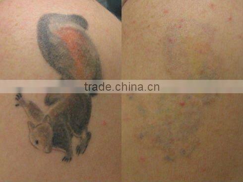 medical aesthetic hair removal ipl laser machine