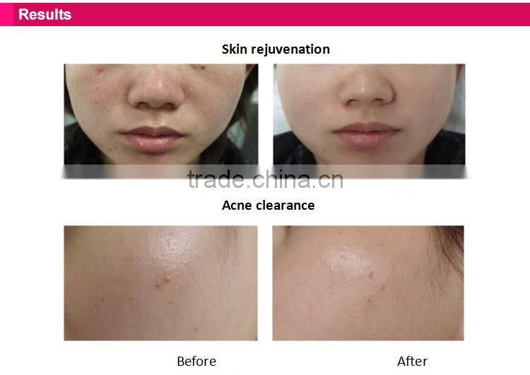 Professional 3 in 1 facial machines for home use with elight(CE, RoHs, PSE approved) skin rejuvenation device with shot counter