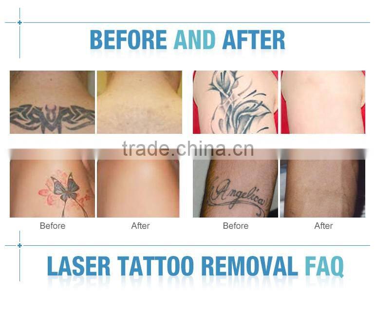 Big power 500w nd yag laser tattoo removal machine with factory price