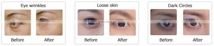 False eyelash extension cold eye patch