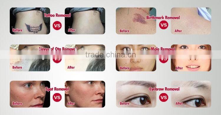 High frequency tattoo removal laser machine china laser