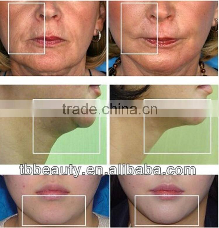 5MHz automatic detection function handheld fractional rf Skin Tightening machine