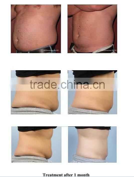Cavitation RF Fat freezing liposuction machine