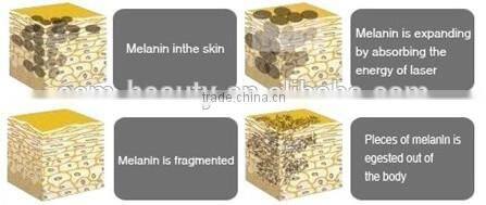 High power q switch nd:yag laser tattoo removal machine