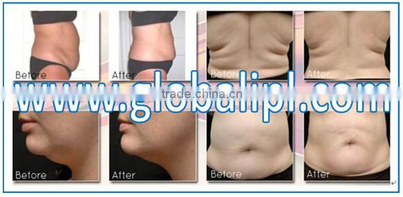 Medical best beauty machine body shaping portable effective rf skin lifting beauty device