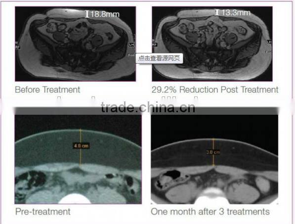 650nm diode laser ultra lipolysis lipo slimming machine CS02