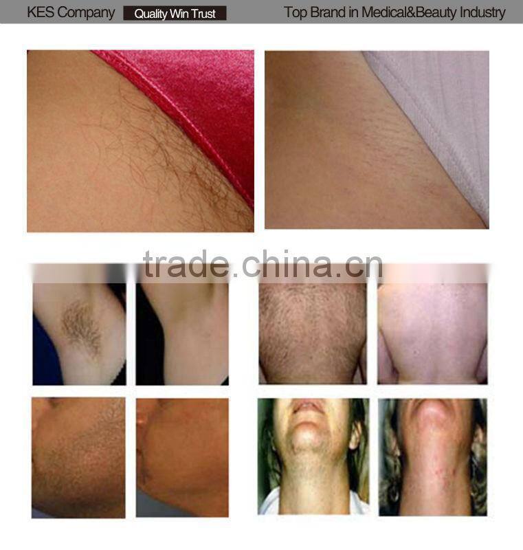Factory Sale!!! Super Hair Removal IPL laser