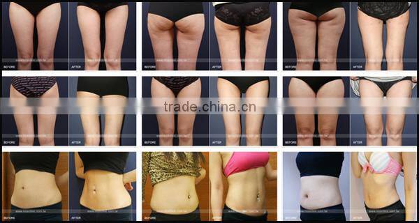 Freeze fats system handle vacuum slimming massager