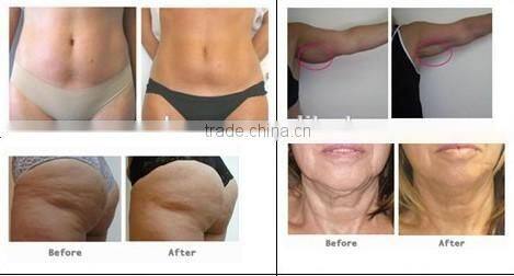 2015 Anti Cellulite Massager Rf Machine