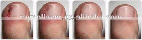 Medical Spa Equipment Alexandrite Laser Permanent Hair Remover for Face