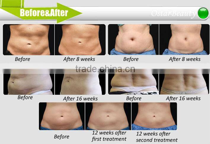 (4 CRYO handle) fat freeze liposuction cryolipolysis body slimming machine