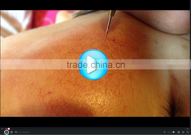 Ultrasound vascular stent spider vein removal face black spot remover machine