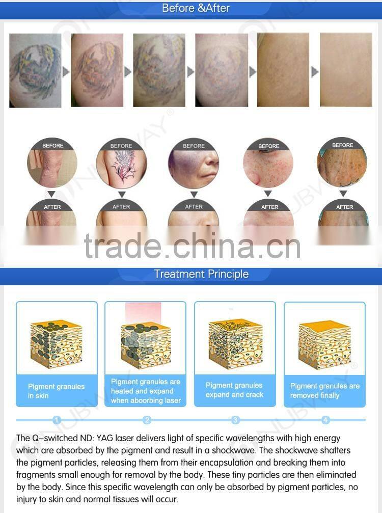 Newest Q switch nd yag laser for tattoo removal for sale