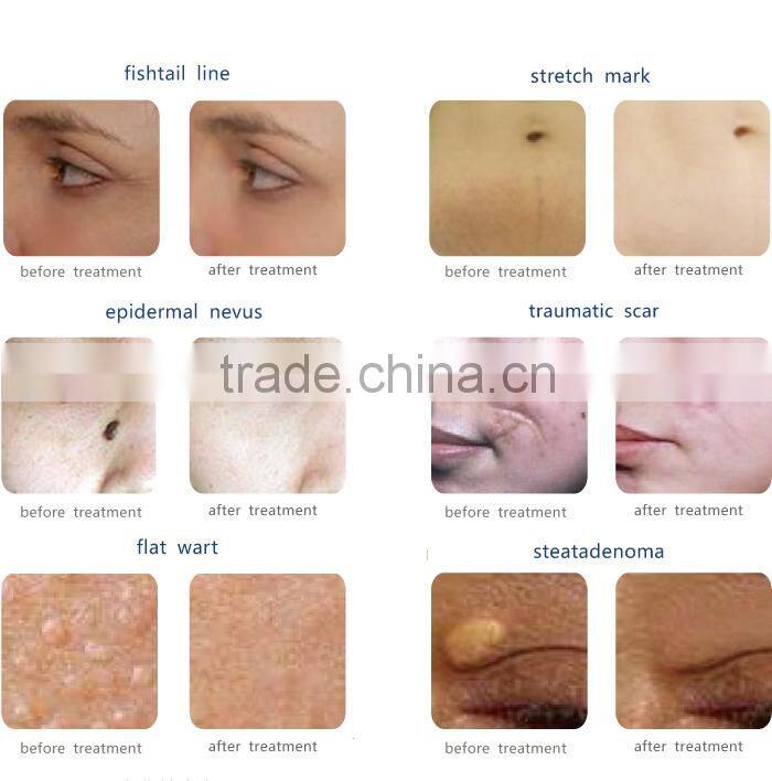 skin resurfacing vagina tighting fractional co2 laser