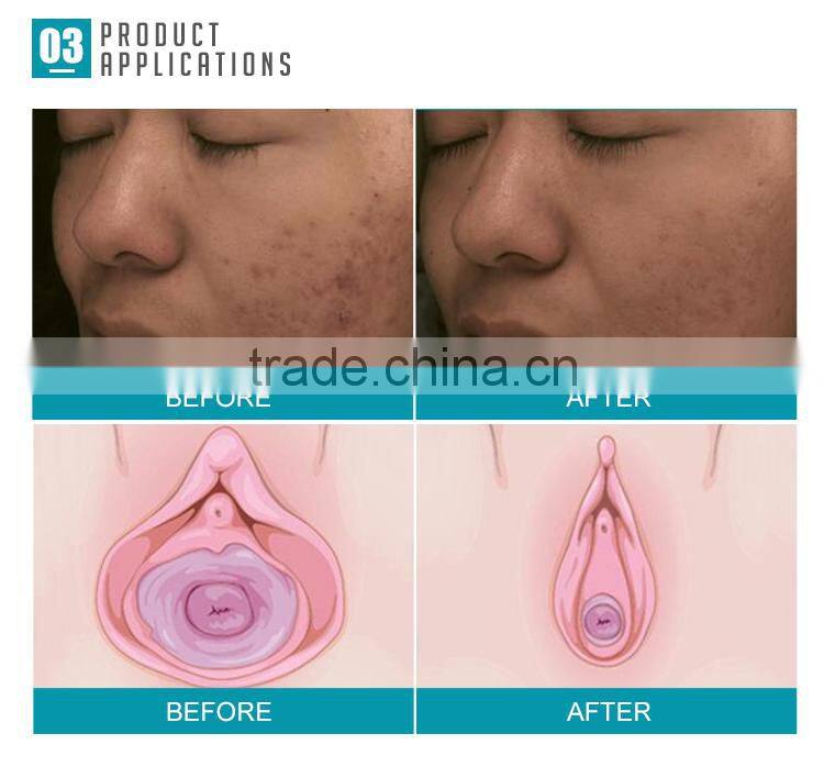 High energy CO2 Laser fractional dark circles removal skin rejuvenation machine