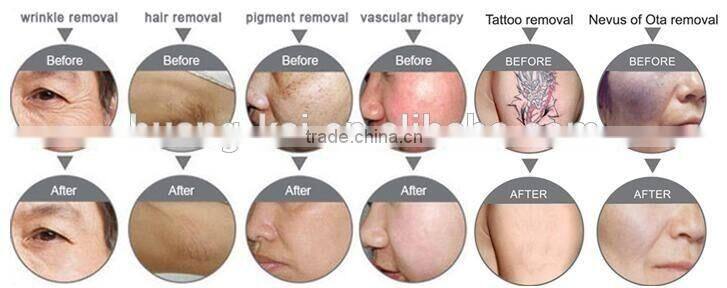 2016 online shopping 3 in 1 elight hair removal / rf / ipl hair removal machine / nd yag laser hair Removal machine