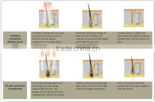 Diode laser dark skin hair removal! long pulse nd yag laser hair removal