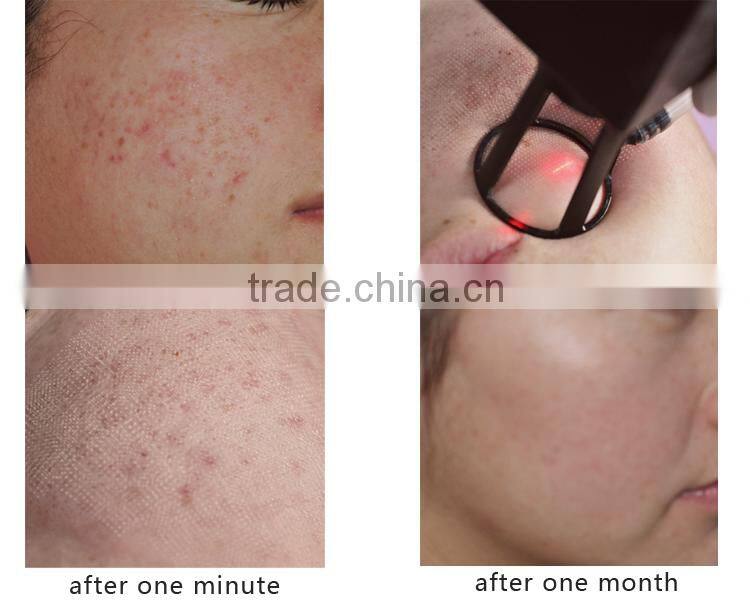 CE approved CO2 laser skin rejuvenation device skin resurfacing before after