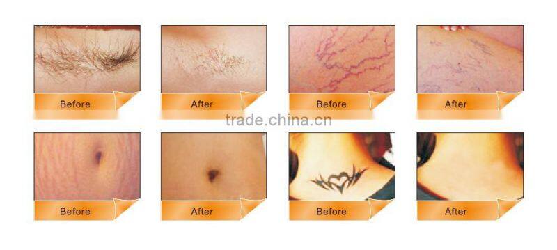 Multifunctional RF skin tighten IPL ND YAG for hair removal tattoo removal