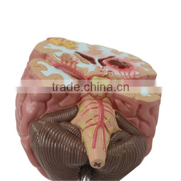 Organs Human Body Anatomy Brain Model Of Stroke